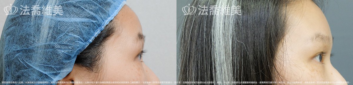 法喬醫美診所,邱浚彥,內視鏡前額五爪拉皮