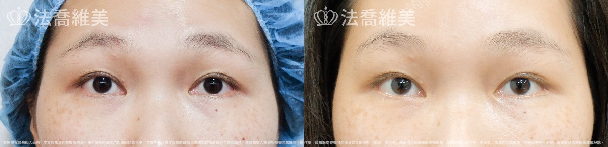 法喬醫美診所,邱浚彥,內視鏡前額五爪拉皮
