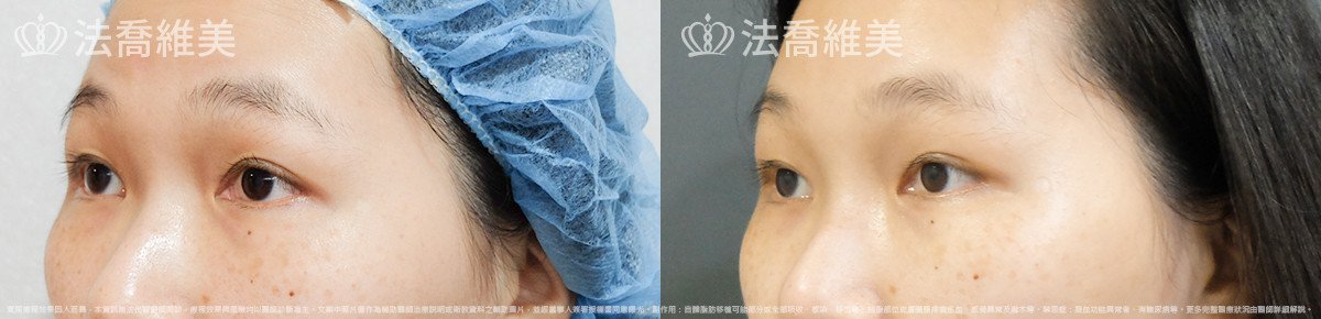 法喬醫美診所,邱浚彥,內視鏡前額五爪拉皮