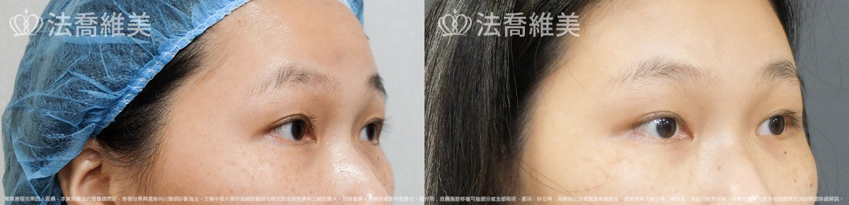 法喬醫美診所,邱浚彥,內視鏡前額五爪拉皮