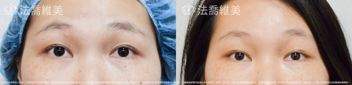 法喬醫美診所,邱浚彥,內視鏡前額五爪拉皮