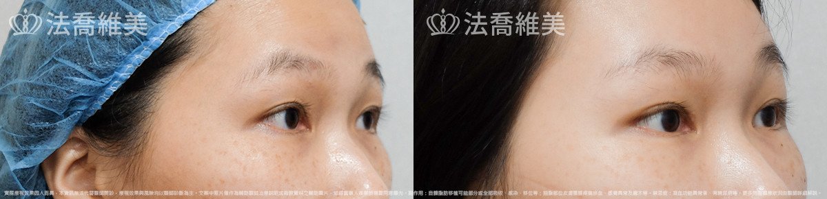 法喬醫美診所,邱浚彥,內視鏡前額五爪拉皮