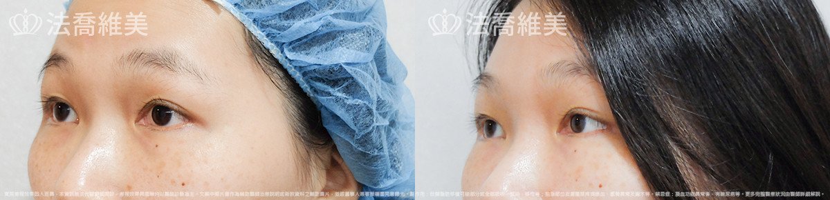 法喬醫美診所,邱浚彥,內視鏡前額五爪拉皮
