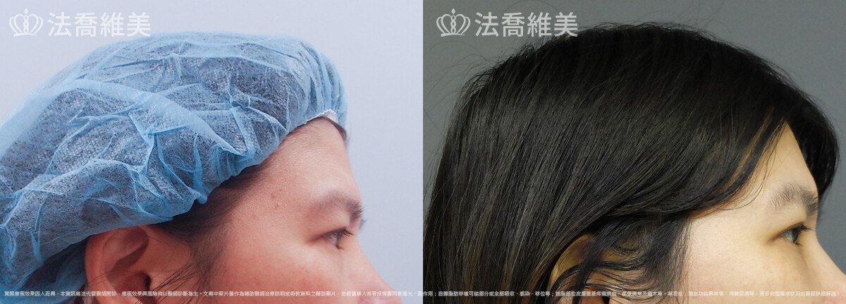 內視鏡前額五爪拉皮