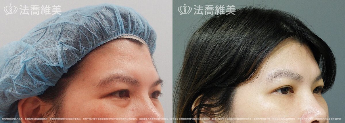 五爪拉皮