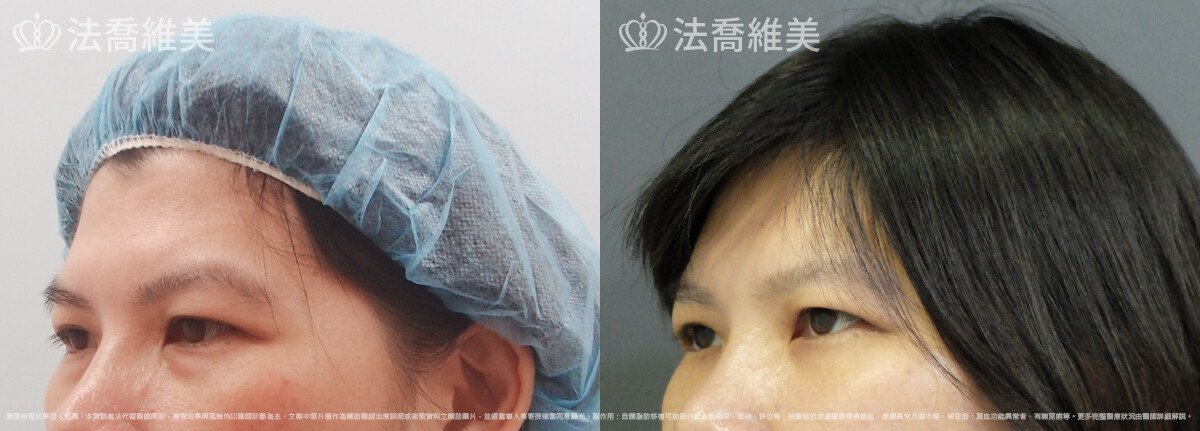 內視鏡前額五爪拉皮