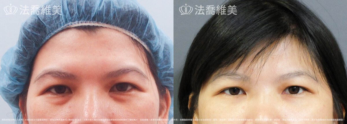 內視鏡前額五爪拉皮