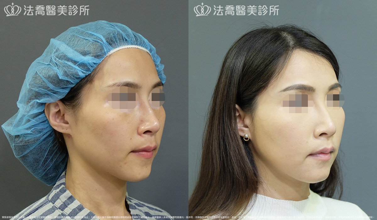 法喬醫美診所,邱浚彥,自體豐全臉