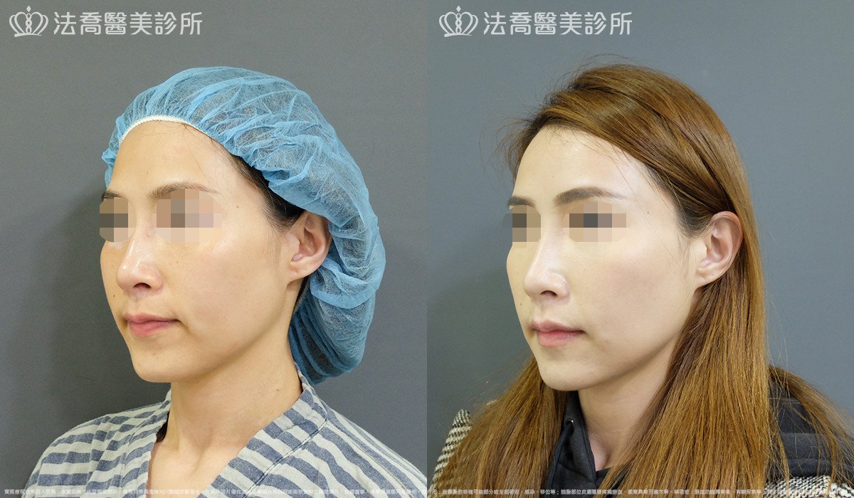 法喬醫美診所,邱浚彥,自體豐全臉