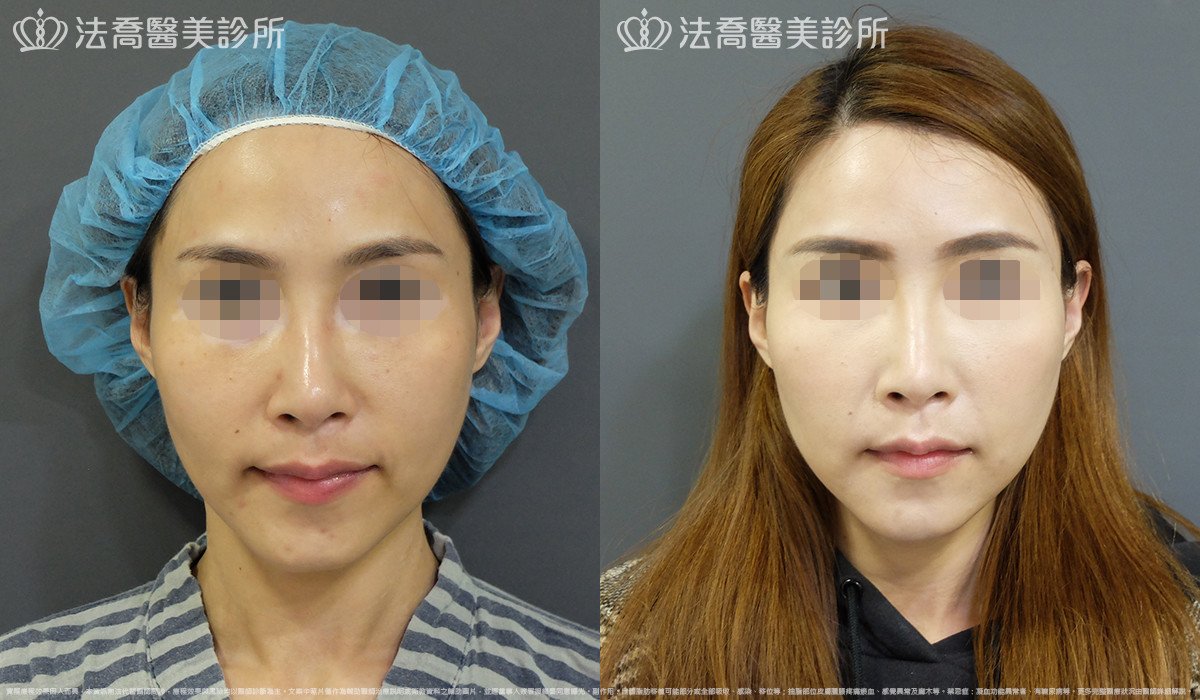 法喬醫美診所,邱浚彥,自體豐全臉