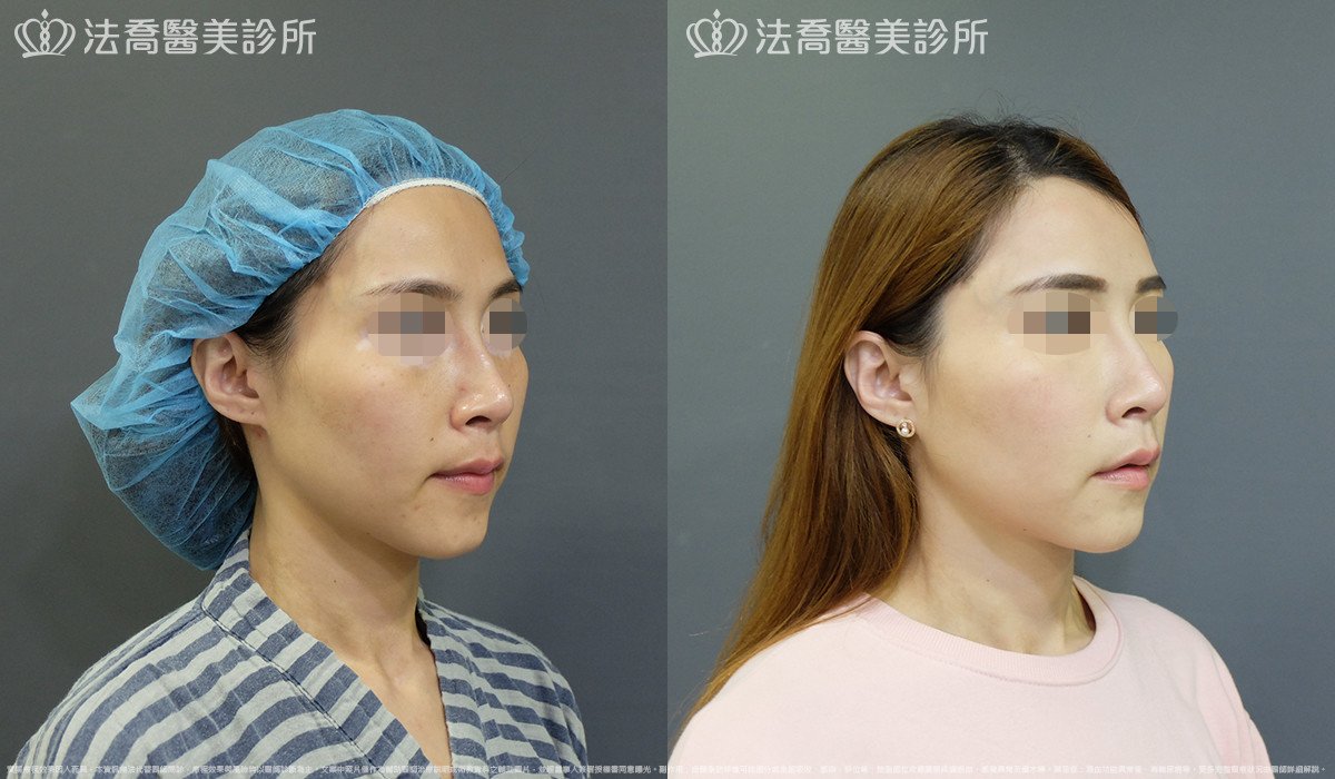 法喬醫美診所,邱浚彥,自體豐全臉