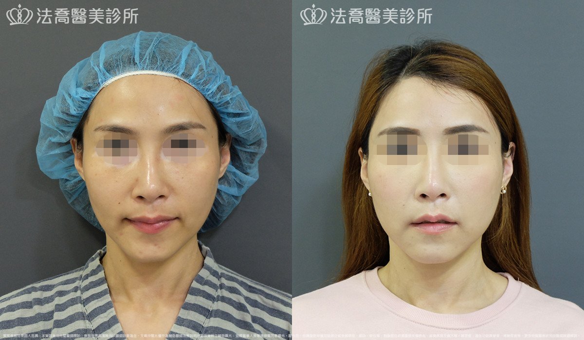 法喬醫美診所,邱浚彥,自體豐全臉