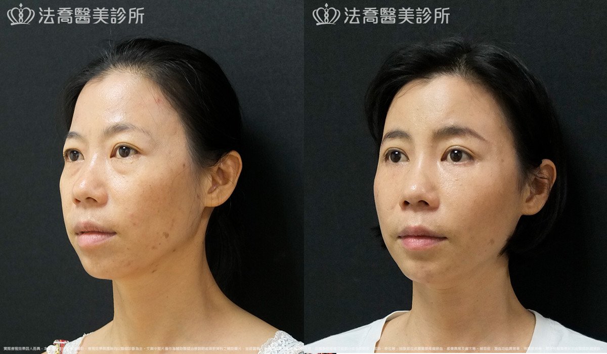 法喬醫美診所,邱浚彥,自體豐全臉