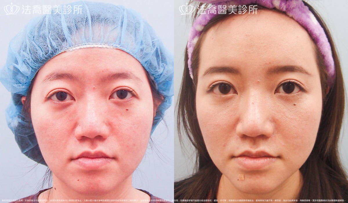 法喬醫美診所,邱浚彥,自體豐全臉