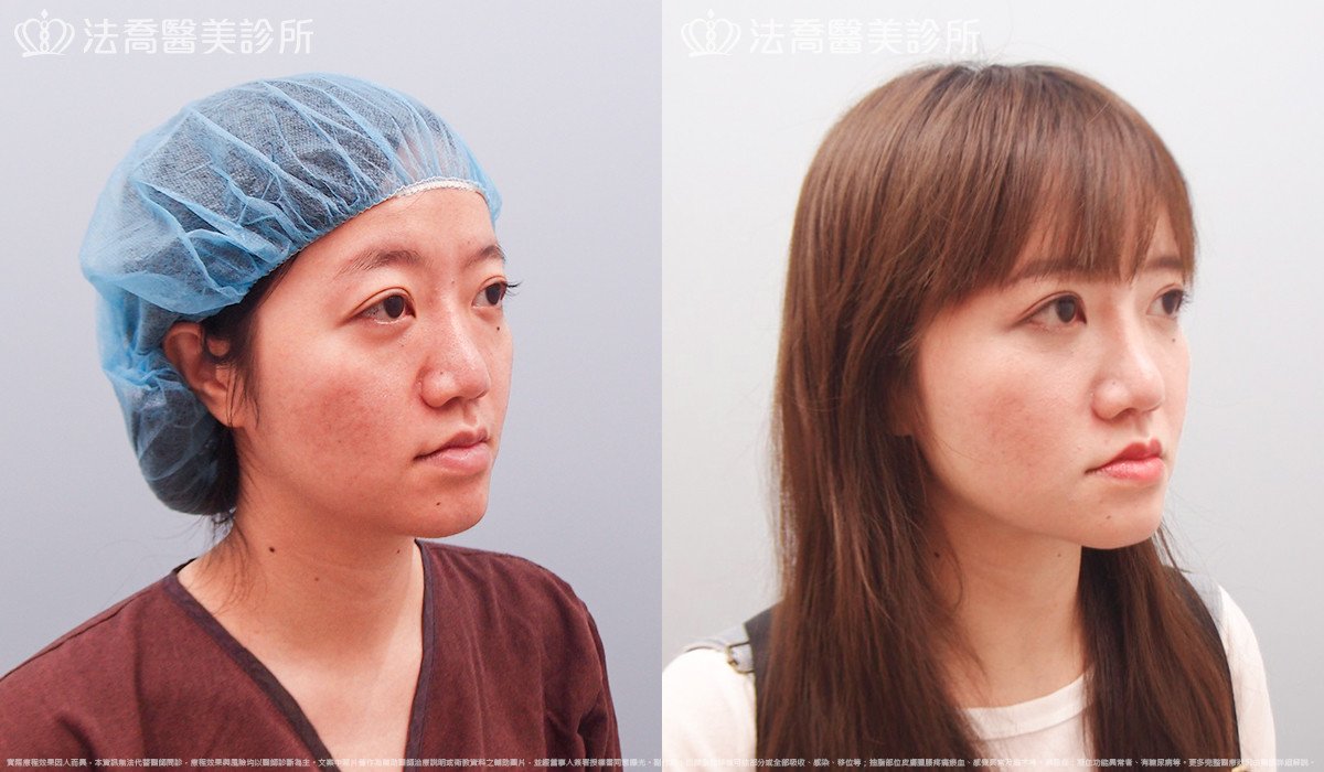 法喬醫美診所,邱浚彥,自體豐全臉