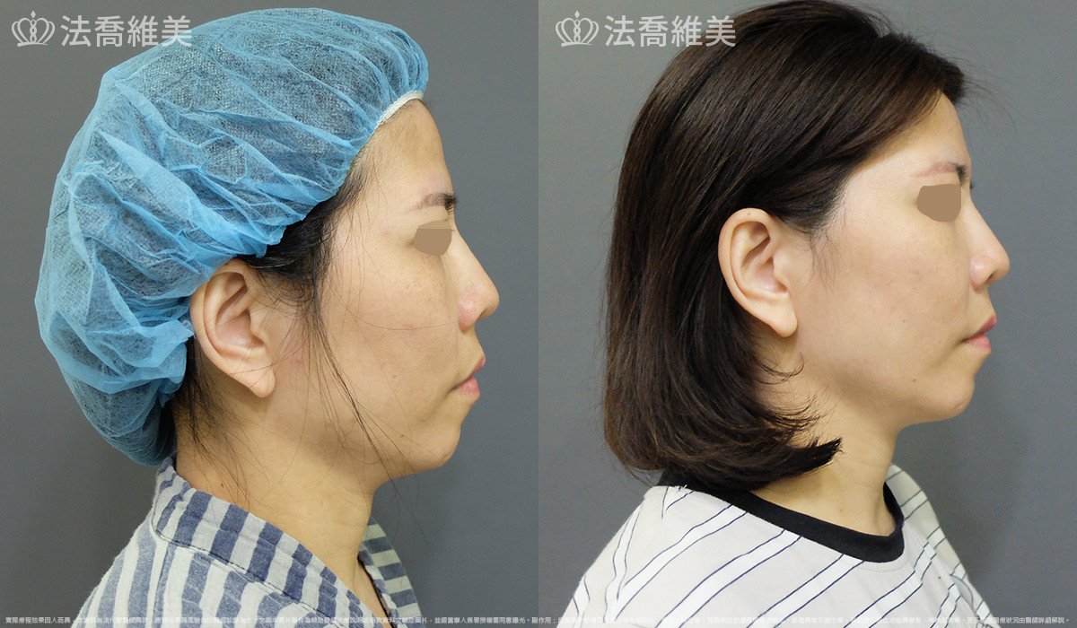 法喬醫美診所,邱浚彥,自體豐全臉