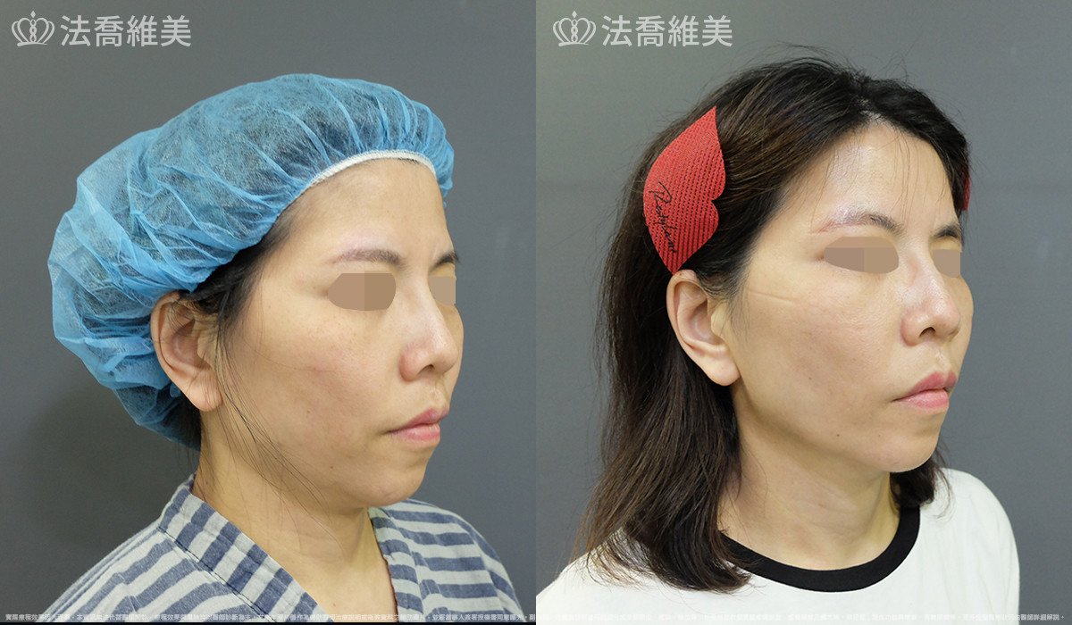 法喬醫美診所,邱浚彥,自體豐全臉