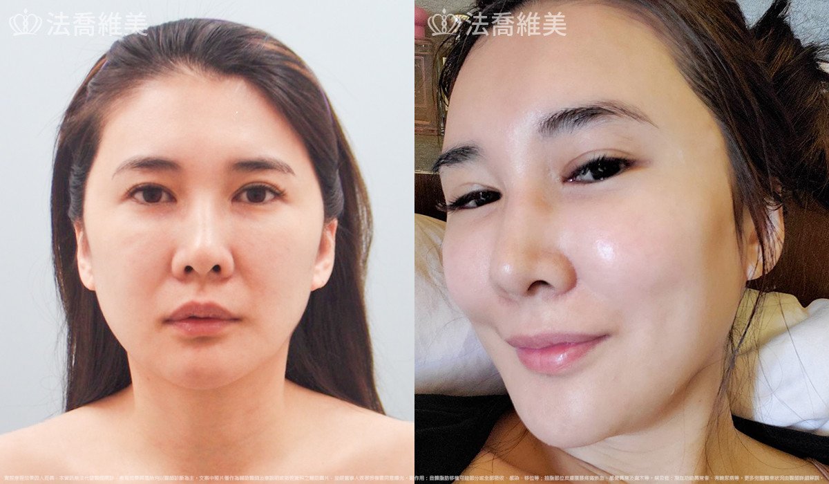 法喬醫美診所,邱浚彥,自體豐全臉