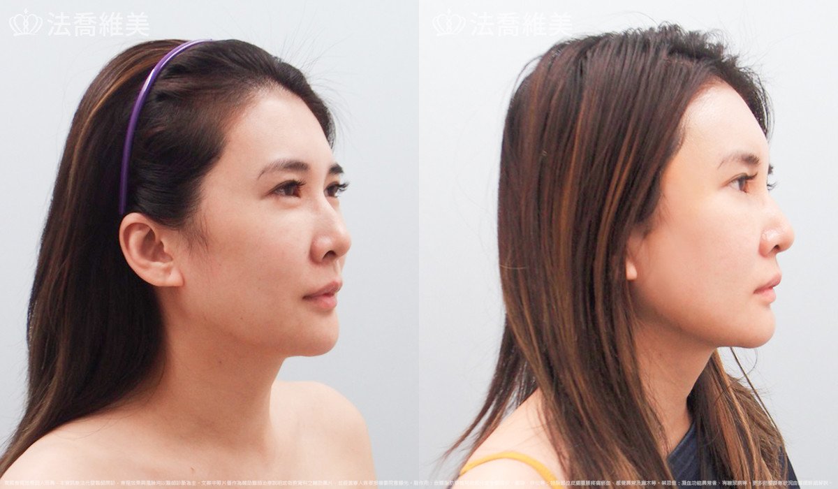 法喬醫美診所,邱浚彥,自體豐全臉