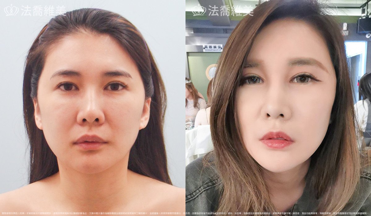 法喬醫美診所,邱浚彥,自體豐全臉