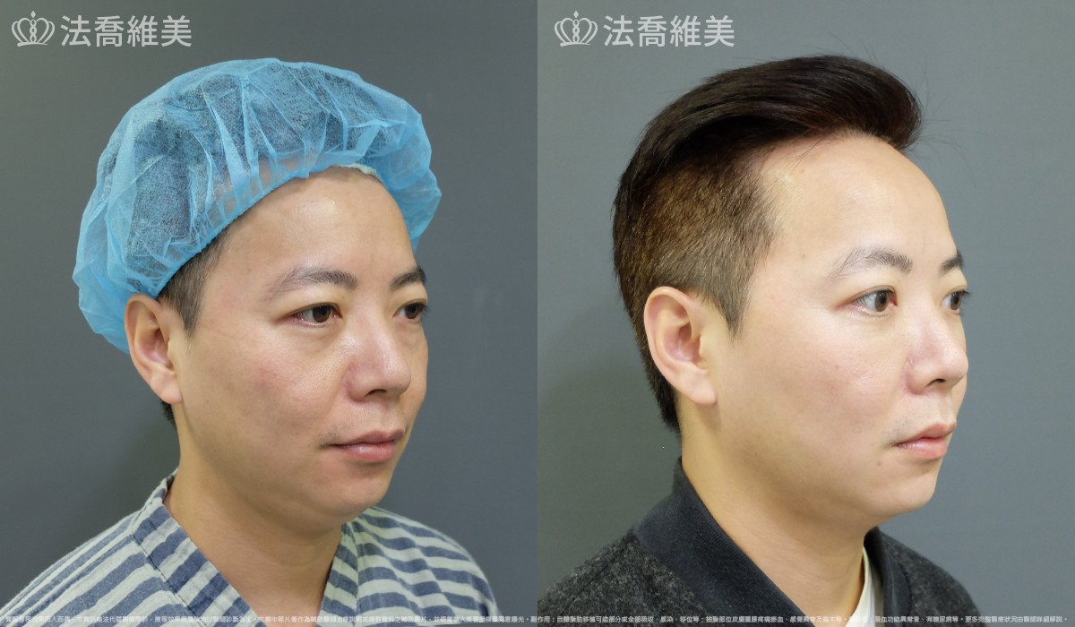 法喬醫美診所,邱浚彥,自體脂肪補蘋果肌及法令