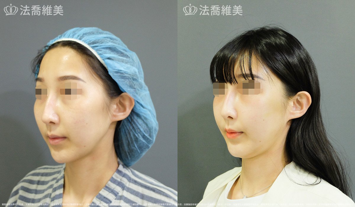 法喬醫美診所,邱浚彥,自體豐全臉