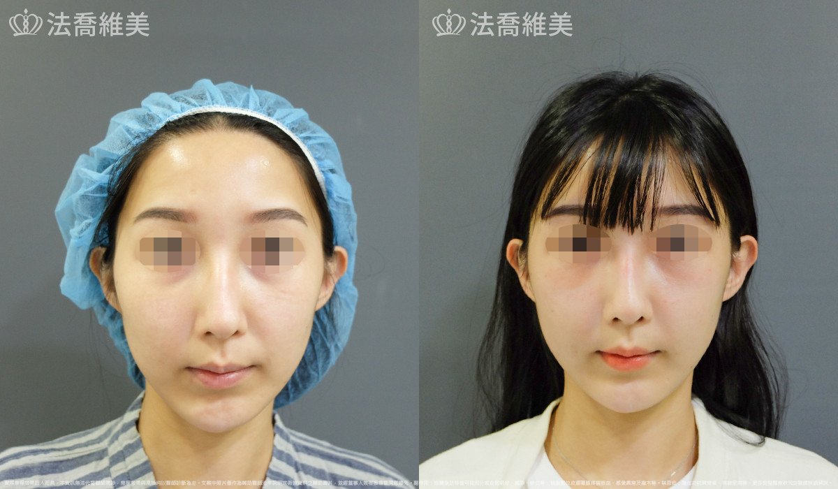 法喬醫美診所,邱浚彥,自體豐全臉