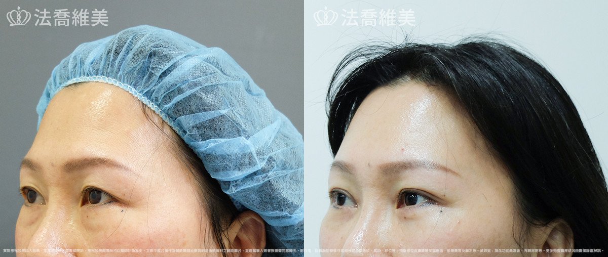 法喬醫美診所,邱浚彥,自體脂肪豐蘋果肌