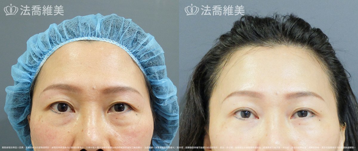 法喬醫美診所,邱浚彥,自體脂肪豐蘋果肌