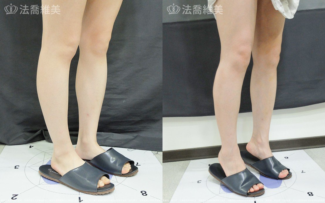 小腿神經截斷術,法喬醫美診所,邱浚彥