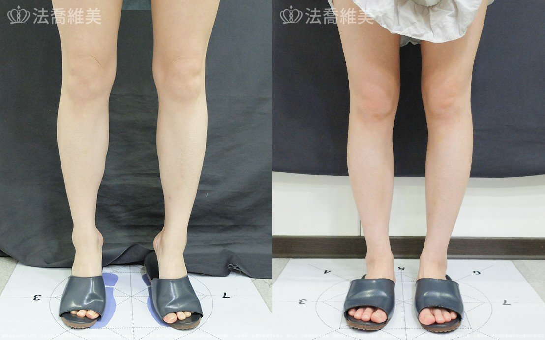 小腿神經截斷術,法喬醫美診所,邱浚彥