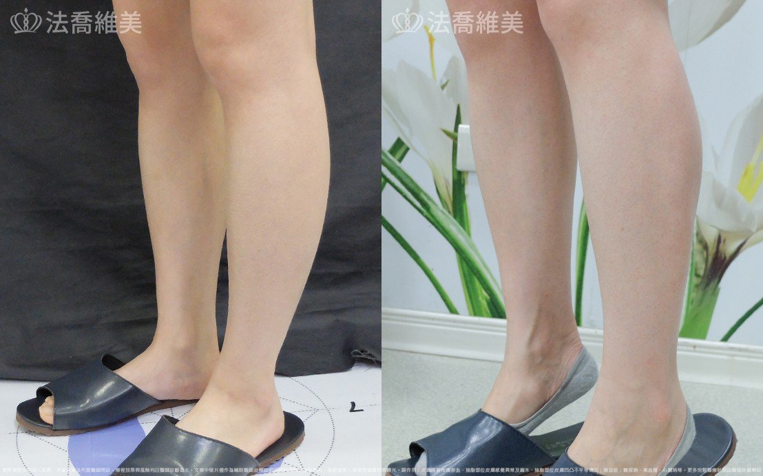 小腿神經截斷術,法喬醫美診所,邱浚彥