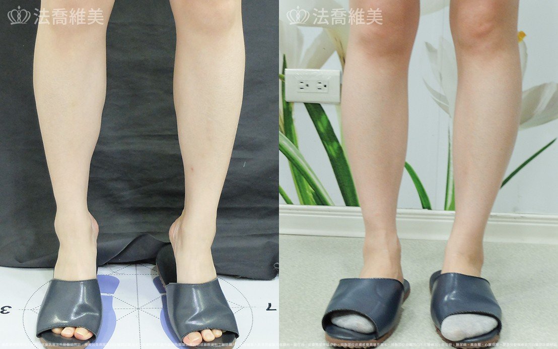 小腿神經截斷術,法喬醫美診所,邱浚彥