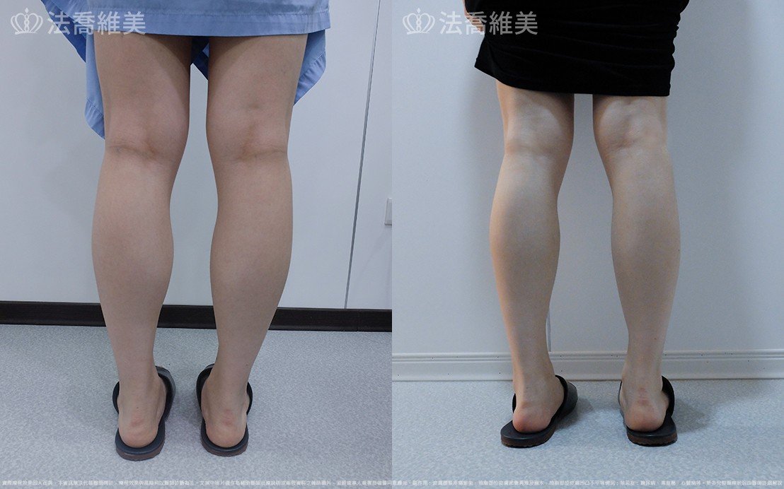 小腿神經截斷術