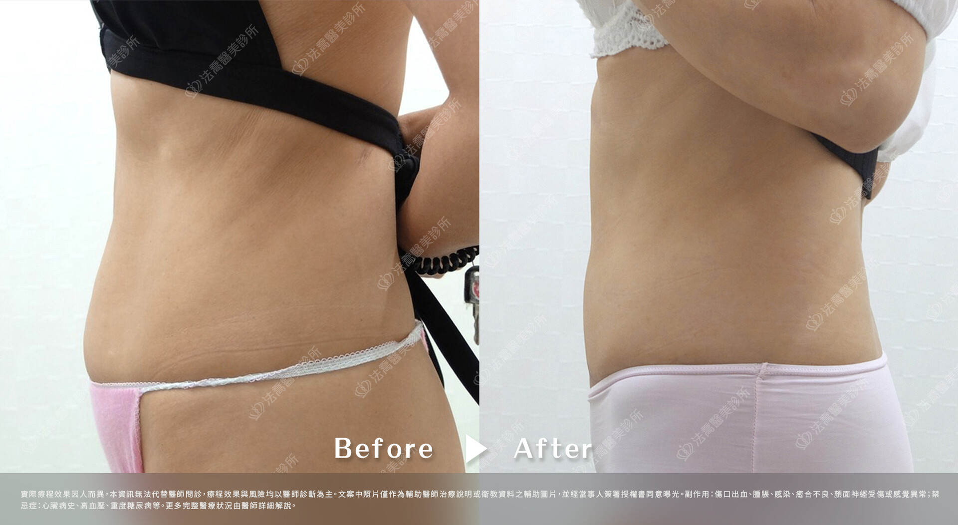 高雄法喬醫美,邱浚彥,抽脂