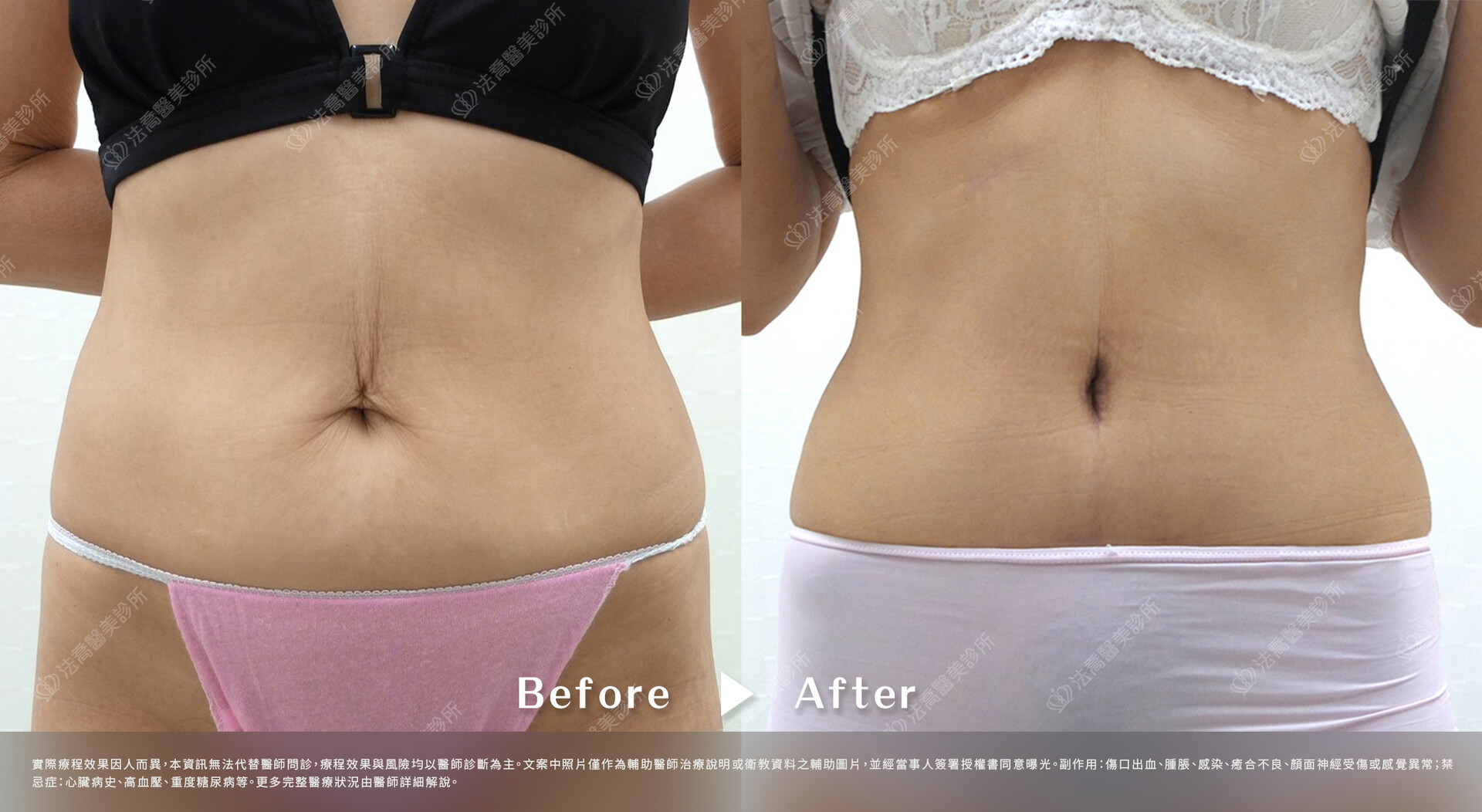 高雄法喬醫美,邱浚彥,抽脂