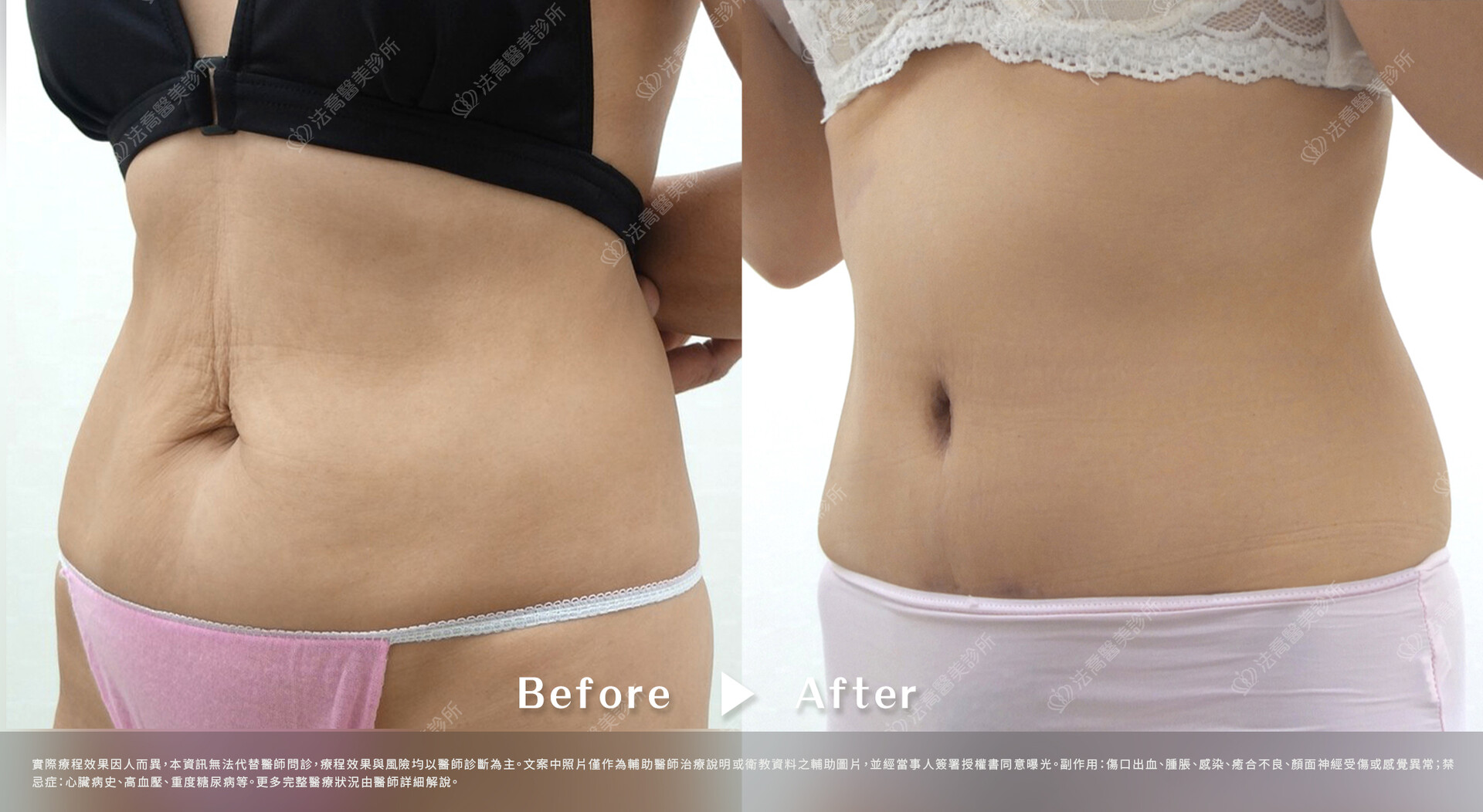 高雄法喬醫美,邱浚彥,抽脂