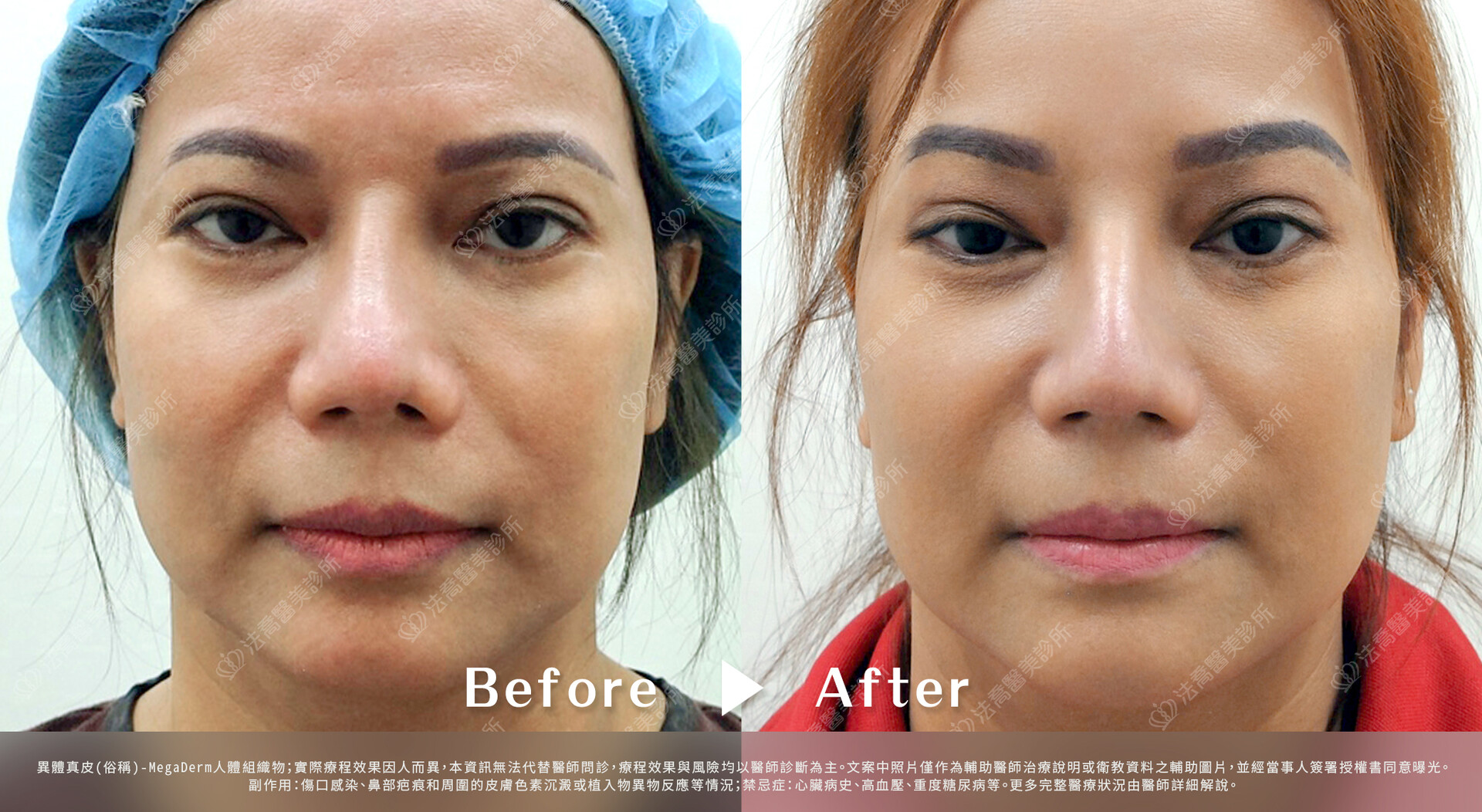 異體真皮(俗稱)隆鼻,耳軟骨墊鼻頭