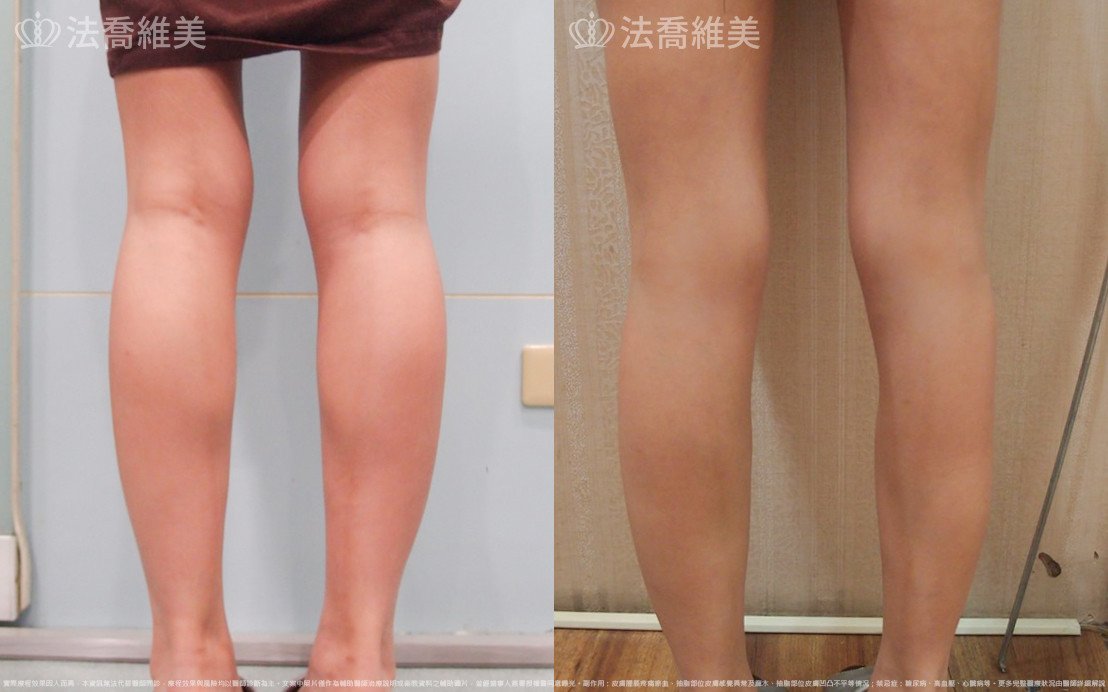 自體肋骨隆鼻,法喬醫美診所,邱浚彥