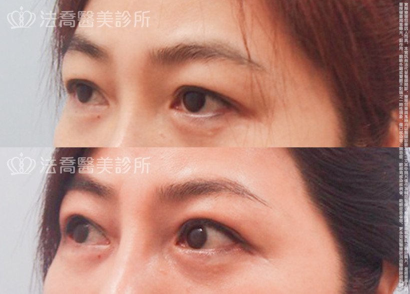 法喬醫美診所,邱浚彥,割雙眼皮,開眼頭,開眼尾