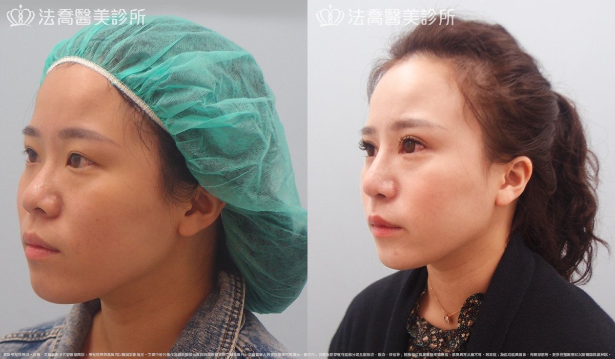法喬醫美診所,邱浚彥,自體肋骨隆鼻