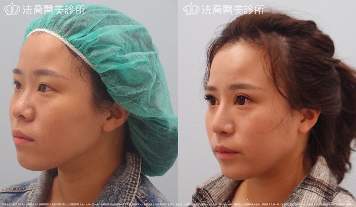 法喬醫美診所,邱浚彥,自體肋骨隆鼻