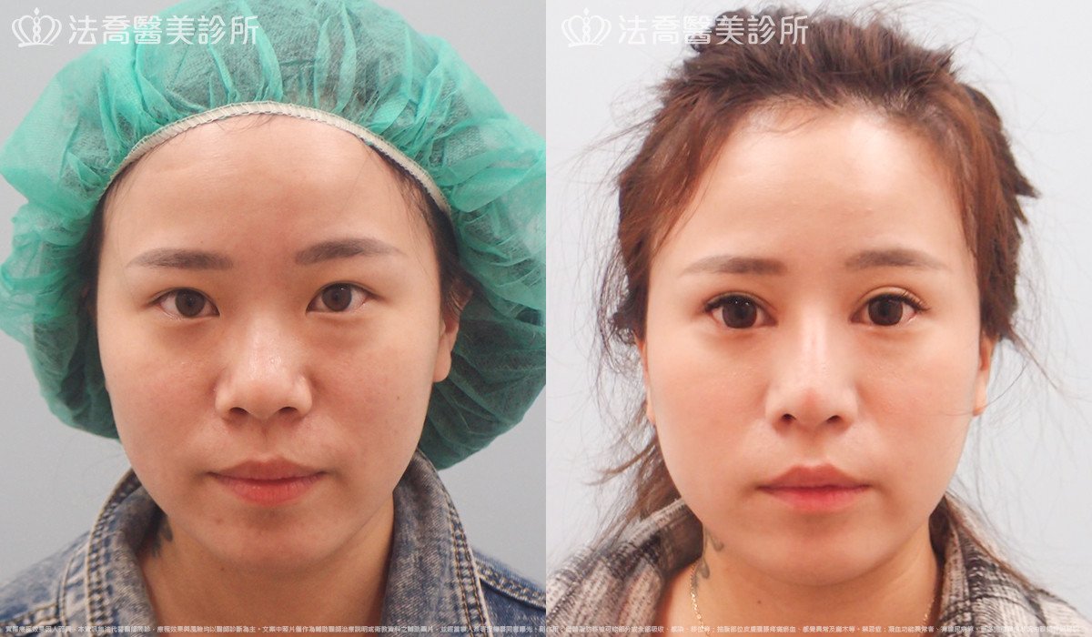 法喬醫美診所,邱浚彥,自體肋骨隆鼻