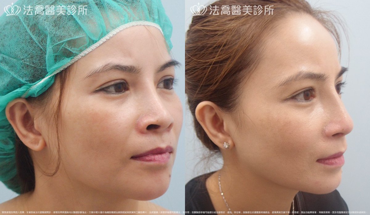 法喬醫美診所,邱浚彥,自體肋骨隆鼻,鼻截骨,縮鼻翼