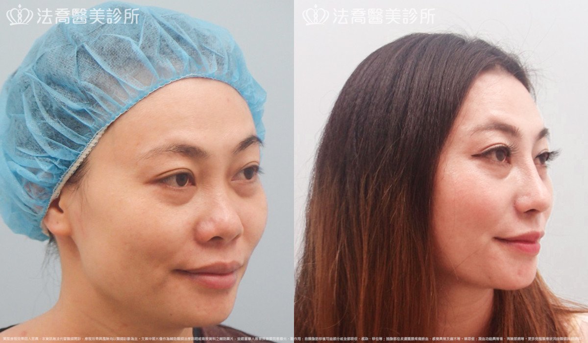 法喬醫美診所,邱浚彥,自體肋骨隆鼻