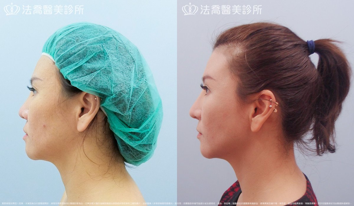 法喬醫美診所,邱浚彥,自體肋骨隆鼻