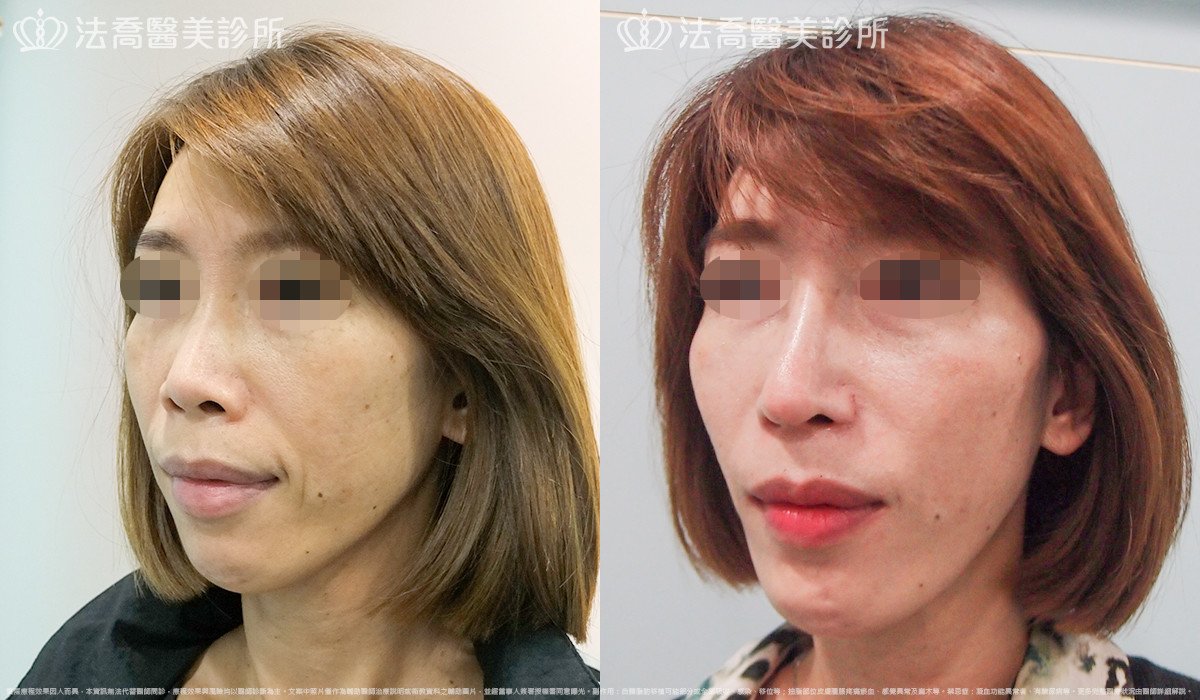 法喬醫美診所,邱浚彥,人工骨墊下巴