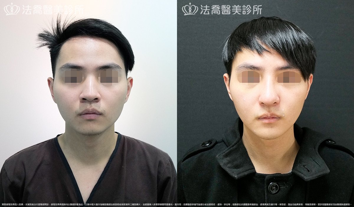 法喬醫美診所,邱浚彥,自體肋骨隆鼻
