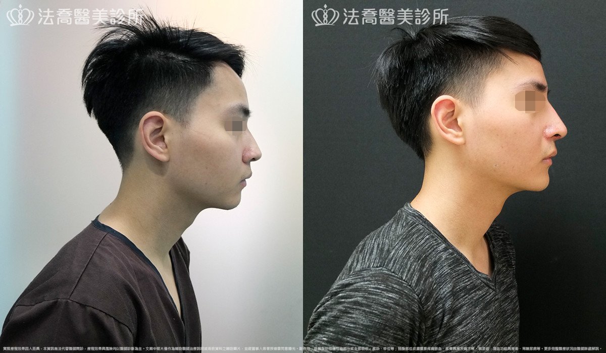 法喬醫美診所,邱浚彥,自體肋骨隆鼻