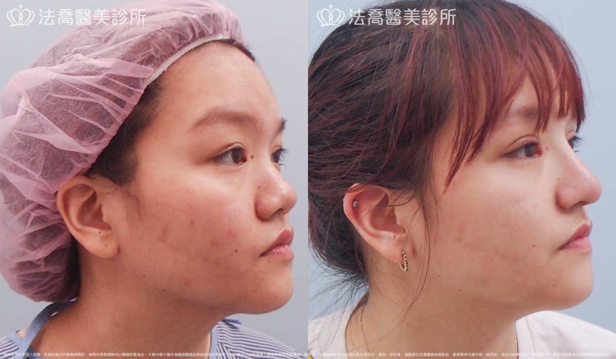 法喬醫美診所,邱浚彥,自體肋骨隆鼻
